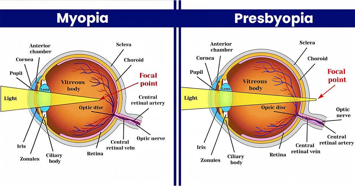Two diagrams illustrating the anatomy of the eye, highlighting differences between presbyopia and myopia.