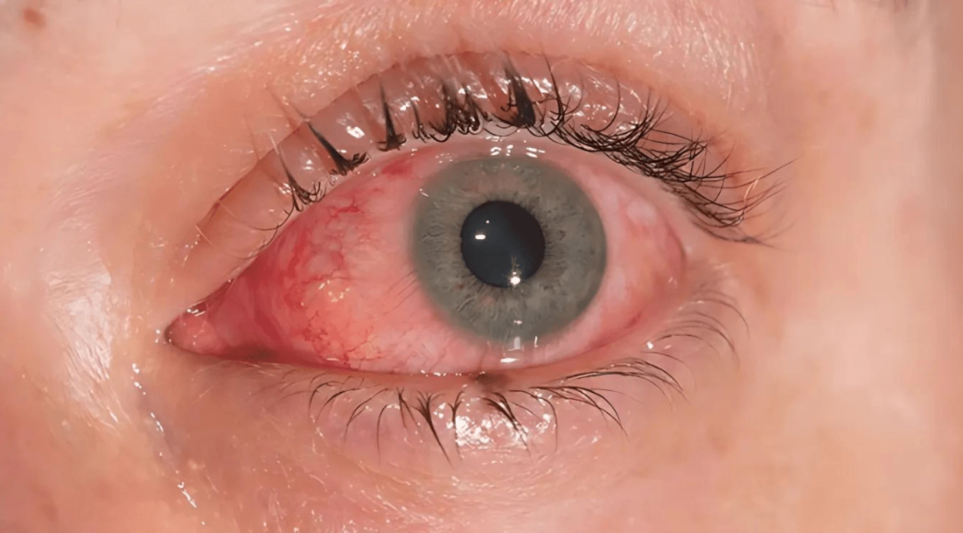 Eye Allergy Specialist in Katy, TX