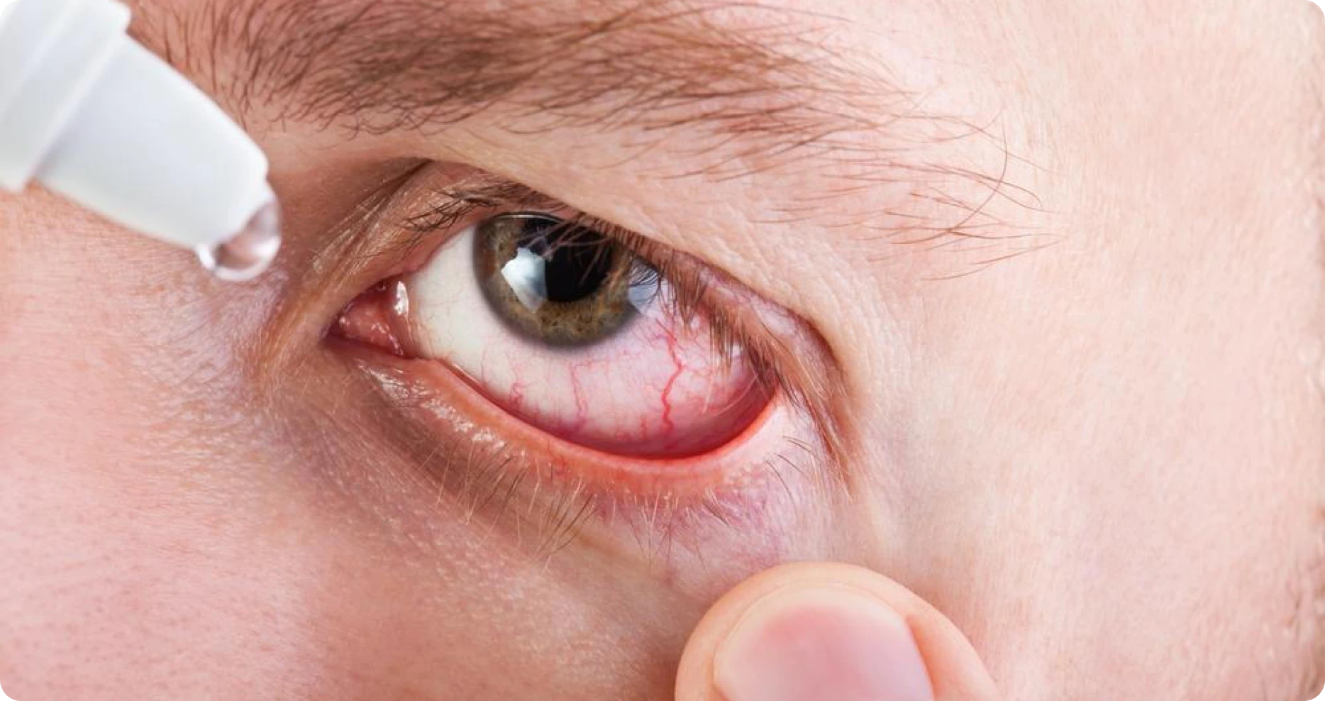 Eye Allergy Specialist in Katy, TX