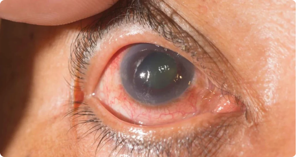 Glaucoma Testing & Treatment with Eye Specialists in Katy, TX