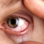 Close-up of irritated red eye showing severe dryness