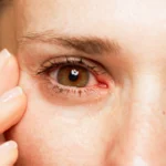 Red eyes from pink eye or allergies