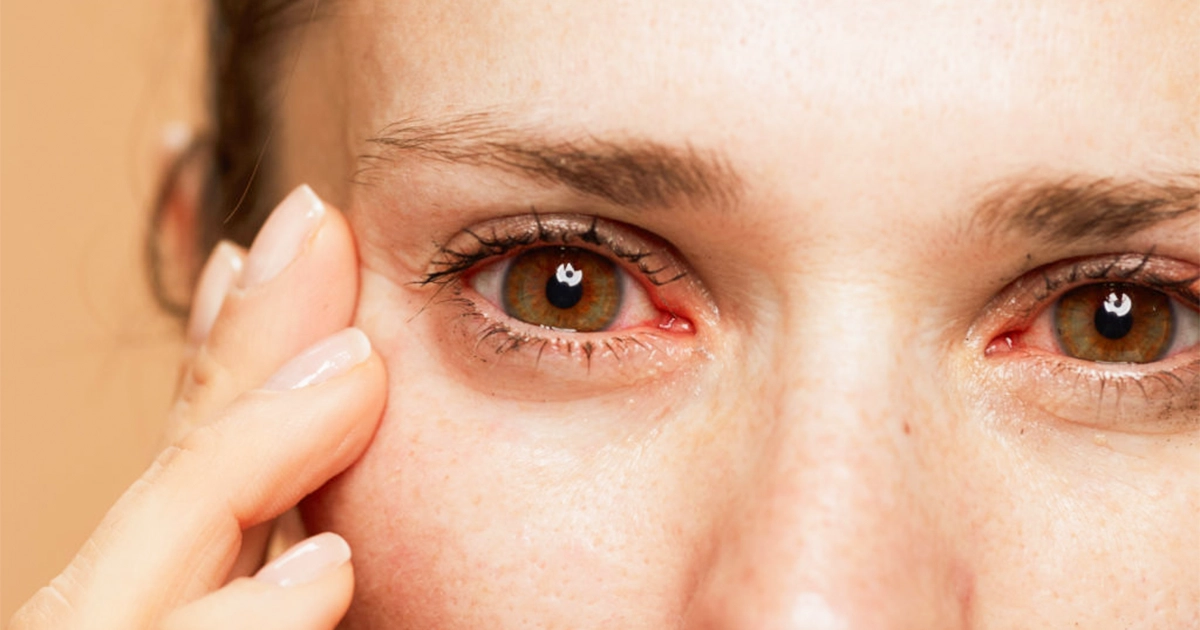 Red eyes from pink eye or allergies