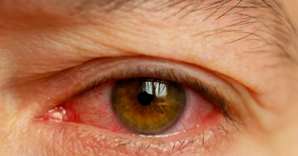 Close-up of a red, irritated eye showing signs of glaucoma.